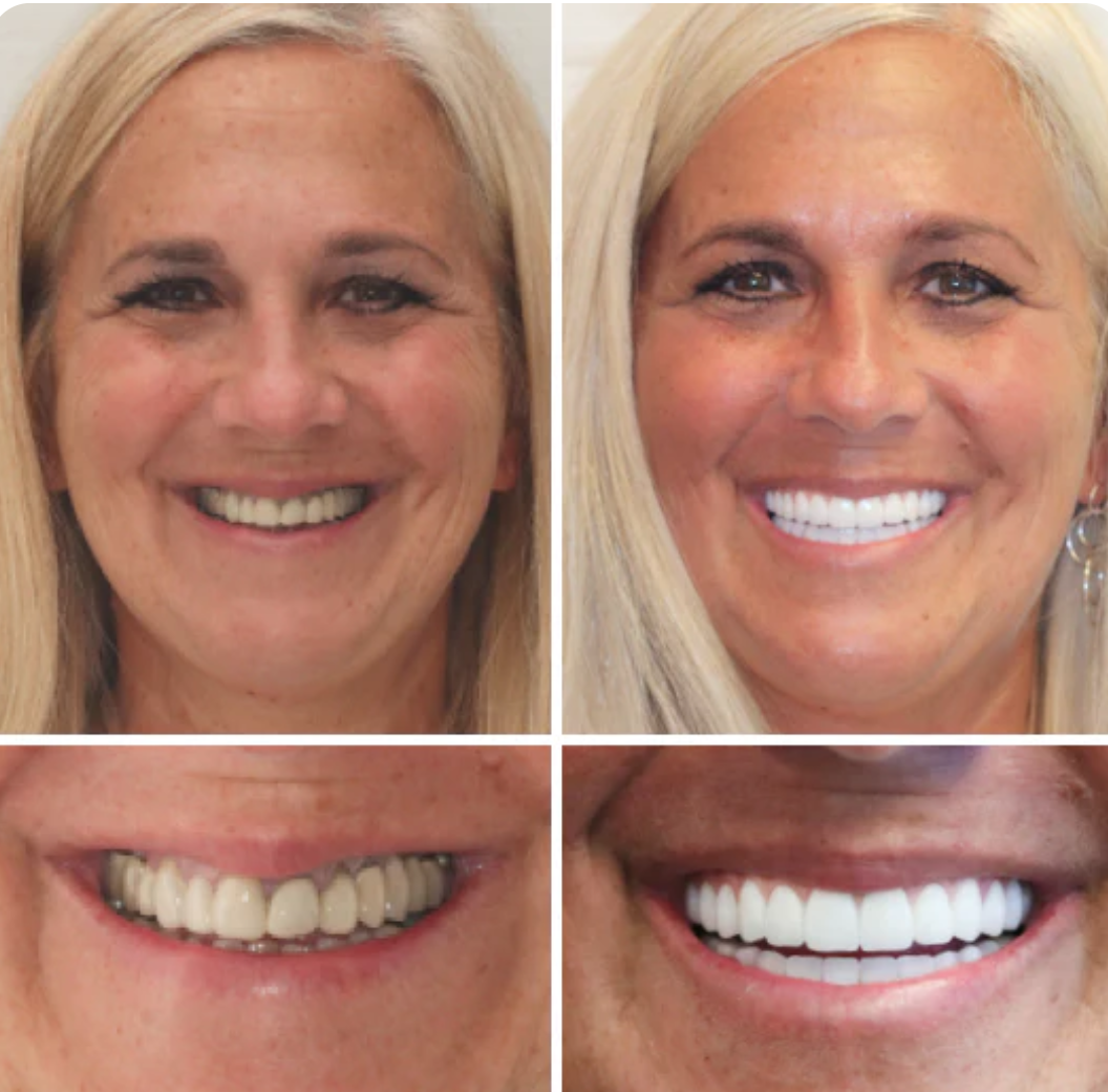 Dentadura Postiza de resina de acrílico dental ¡Recupera tu sonrisa sin dolor ni odontólogos! | – con el 50% de descuento solo por hoy