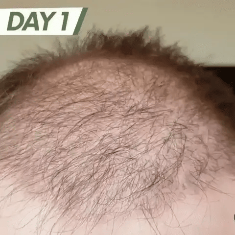 Tratamiento efectivo para el crecimiento del cabello y la barba. CON MINOXIDIL 5% 🎁 50% DSCNTO