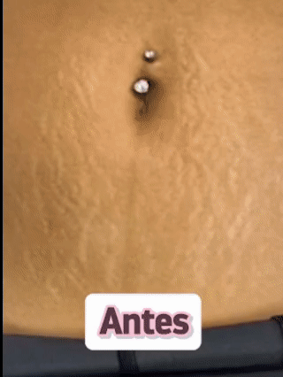 Hydrastrik – El tratamiento que mejora tus estrías y celulitis con 50% de DESCUENTO